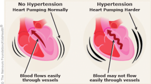 Image showing how hypertension occurs.