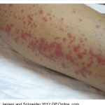 Skin rash in Leptospirosis