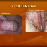 Fungal[yeast] infection of genitals in diabetes mellitus