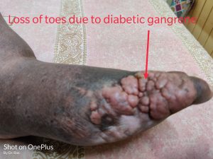 Diabetic microangiopathy leading to gangrene and amputation of fingers of the foot.