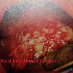Candida infection of the oral cavity -Oral Thrush