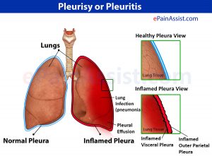 Chest pain due to inflammation of the covering of lungs[pleura]
