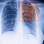  Severe chest pain due to Fractured rib