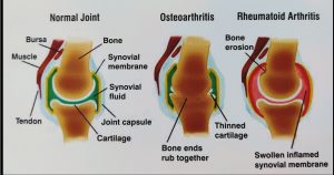 Picture showing difference between rheumatoid and osteoarthritis