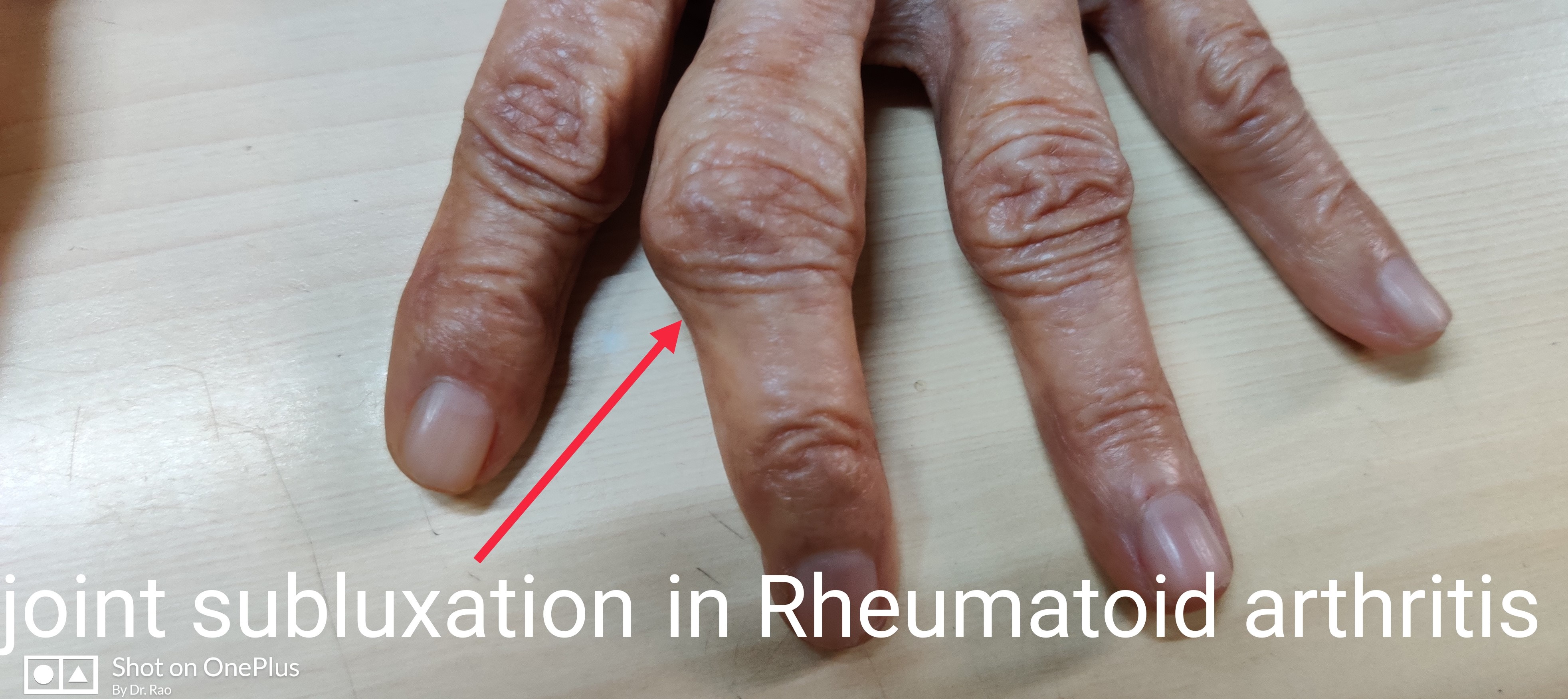 WHAT IS ARTHRITIS? KNOW ALL ABOUT IT HERE