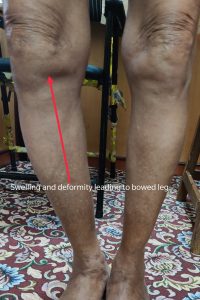 Bowed legs in osteoarthritis of Right Knee