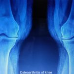 X-ray of Knee Joint affected by Osteoarthritis