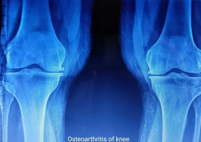 X-ray picture of osteoarthritis of the knee