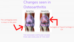 Picture showing changes observed in Osteoarthritis 