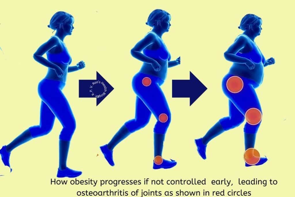 Image showing progress and effects of Obesity