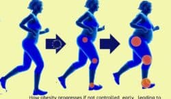 Image showing progress and effects of Obesity