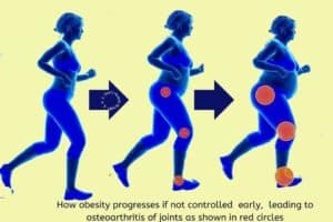 Obesity part 2-know your bmi, waist to hip ratio