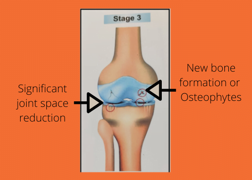 Third Stage of Osteoarthritis showing further narrowing of joint space and new bone formation or osteophytes