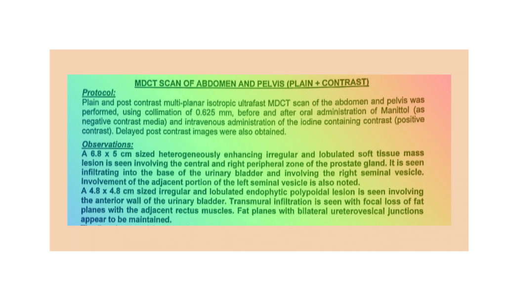 The ct scan report of a prostate cancer patient