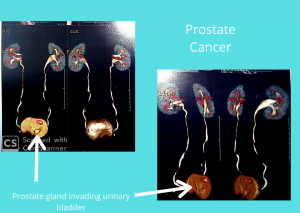 Prostatic Cancer picture