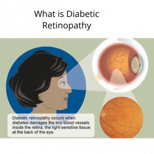 Complication of Diabetes-Retinopathy