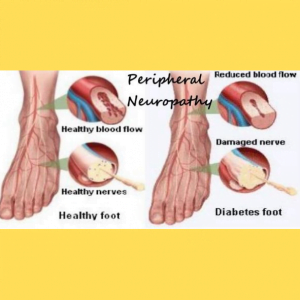 A complication of diabetes-peripheral neuropathy