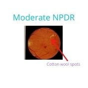 Moderate non- proliferative retinopathy of diabetes 