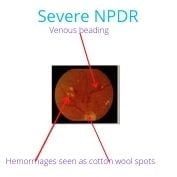 Severe non-proliferative retinopathy of diabetes