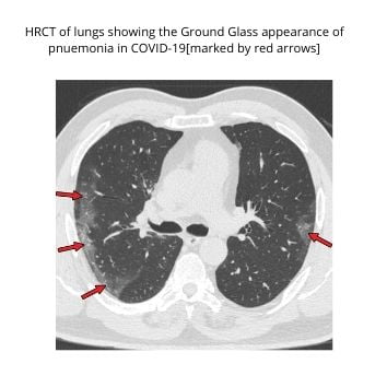 HRCT image of lungs in COVID-19 pnuemonia