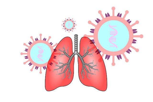 PICTURE SHOWING COVID-19 INFECTION OF LUNGS