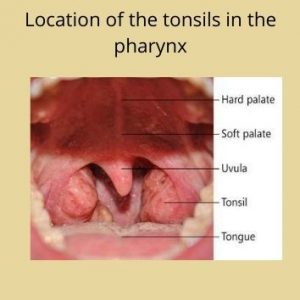 Tonsillitis in Acute Common Bacterial disease