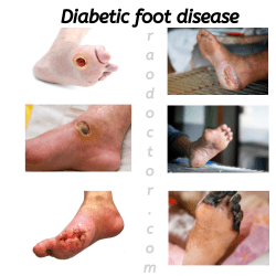Diabetic foot disease 2