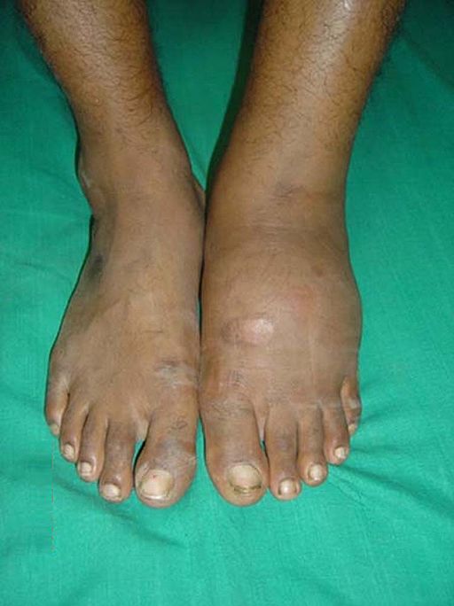 Image showing charcot foot deformity in a diabetic patient.