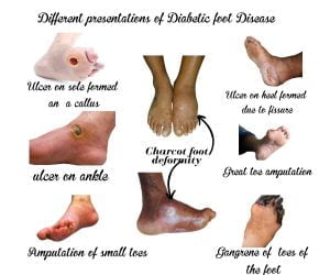 Image showing different presentations of diabetic foot disease