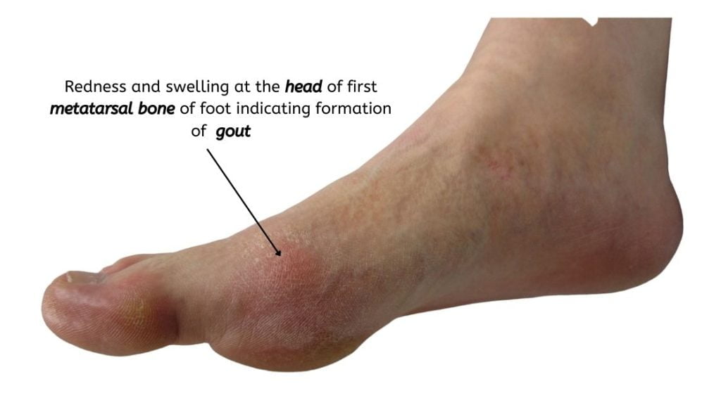 Picture showing gout formation in the right foot 