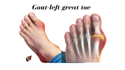 Picture showing gout in left great toe