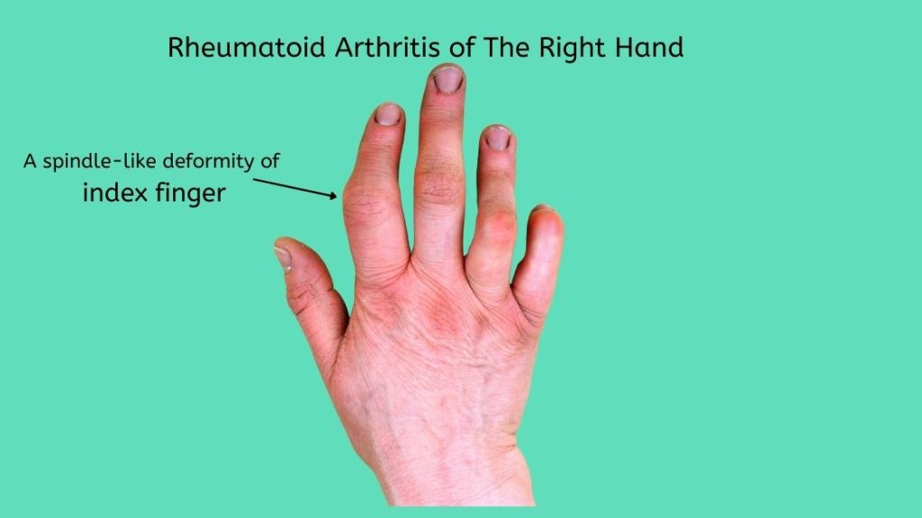 Picture showing Rheumatoid Arthritis of the right hand with spindle-like deformity of the index finger.