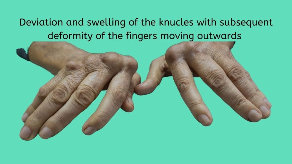 Deviation of knuckles due to deformity caused by rheumatoid arthritis