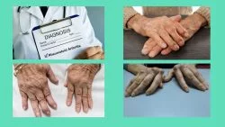 Picture showing rheumatoid arthritis