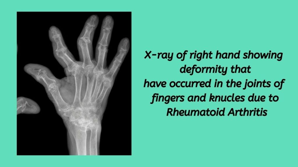 X-ray showing changes in Right hand fingers due to Rheumatoid Arthritis