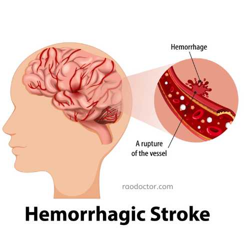 Stroke due to hemorrhage in the brain