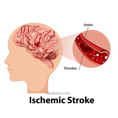 Stroke due to lack of blood supply to the brain