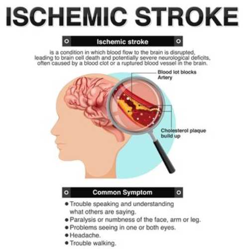 Ischemic stroke illustration