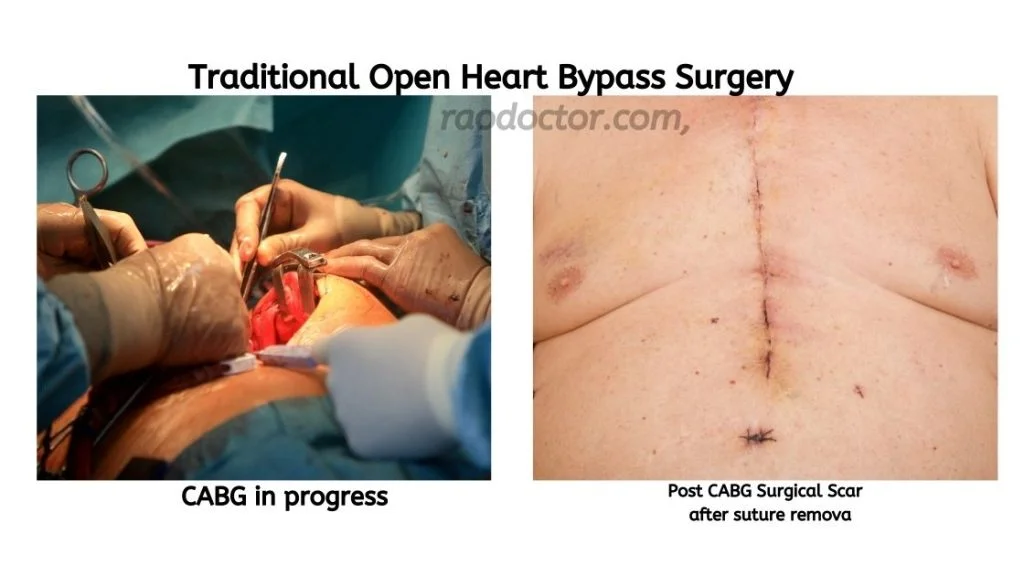 Open heart cabg