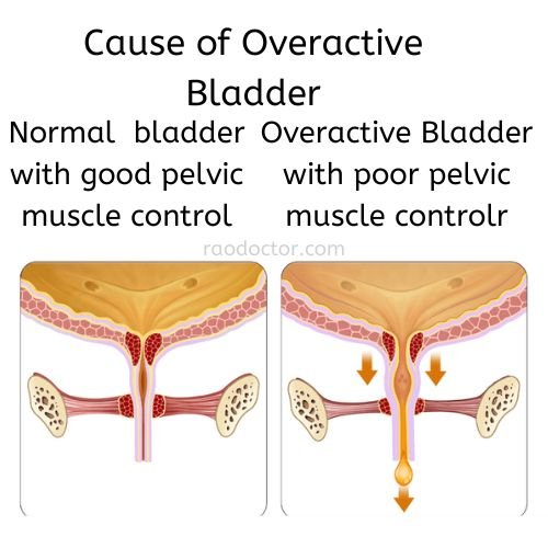 Cause of Overactive Bladder