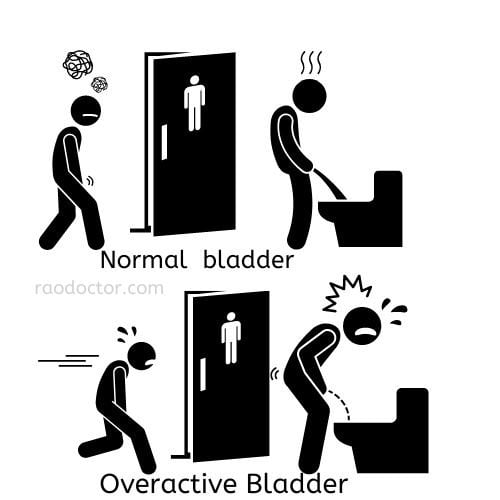 image vector showing presentation of an overactive bladder