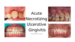 Picture showing Acute Necrotizing Ulcerative Gingivitis