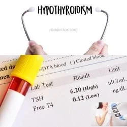 Hypothyroidism feature pictutre