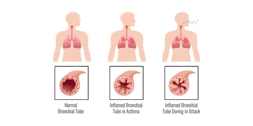 Picture showing what happens in a asthma attack