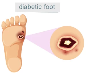 Diabetic Foot Disease