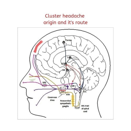 Diagram showing how cluster headache occurs