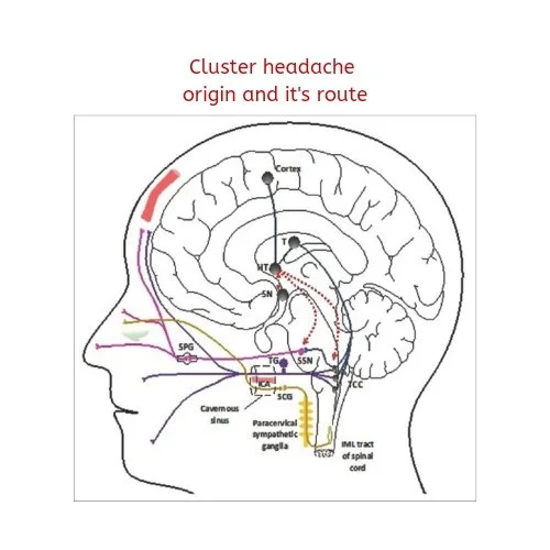 Cluster Headache: What You Need to Know and What You Can Do 4 Diagram showing how cluster headache occurs