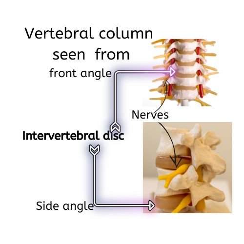 Picture showing vertebral disc herniation causing backache