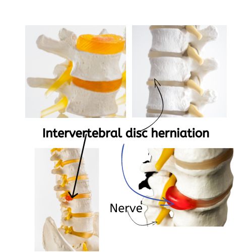 Picture showing how a slipped disc bulges and protrudes on nerve causing sciatica