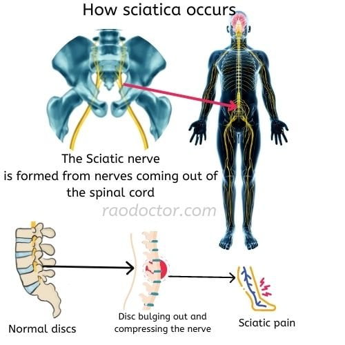 The anatomy and pain pathway in sciatica